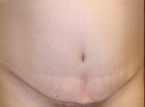 Tummy Tuck Before & After Patient #737