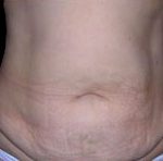 Tummy Tuck Before & After Patient #732