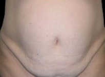 Tummy Tuck Before & After Patient #737