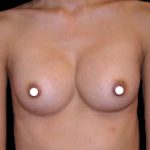 Breast Augmentation (Saline) Before & After Patient #473
