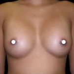 Breast Augmentation (Saline) Before & After Patient #475
