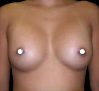 Breast Augmentation (Saline) Before & After Patient #475