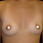 Breast Augmentation (Saline) Before & After Patient #476