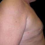 Gynecomastia Before & After Patient #633