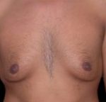 Gynecomastia Before & After Patient #636