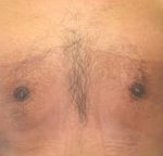 Gynecomastia Before & After Patient #636
