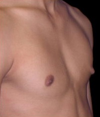 Gynecomastia Before & After Patient #638