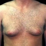 Gynecomastia Before & After Patient #644