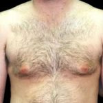 Gynecomastia Before & After Patient #644