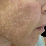 Laser Skin Resurfacing Before & After Patient #1225