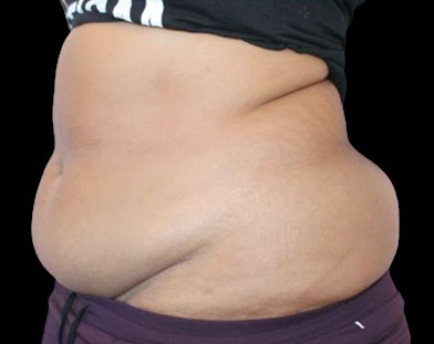 Tummy Tuck Before & After Patient #748