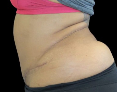 Tummy Tuck Before & After Patient #748