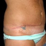 Tummy Tuck Before & After Patient #730
