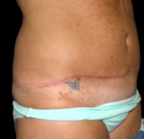 Tummy Tuck Before & After Patient #730