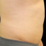Tummy Tuck Before & After Patient #739