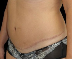 Tummy Tuck Before & After Patient #740