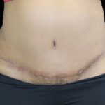 Tummy Tuck Before & After Patient #742