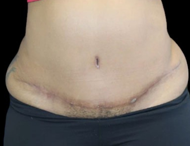 Tummy Tuck Before & After Patient #742