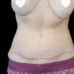 Tummy Tuck Before & After Patient #746