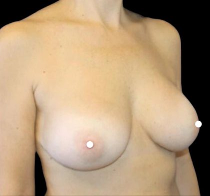 Breast Augmentation (Revision) Before & After Patient #1446