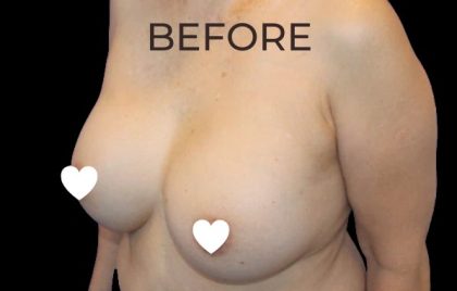 Breast Augmentation (Revision) Before & After Patient #591