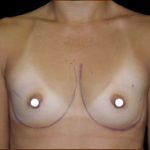 Breast Augmentation (Saline) Before & After Patient #470