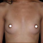 Breast Augmentation (Saline) Before & After Patient #472