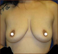 Breast Augmentation (Saline) Before & After Patient #478