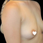 Breast Augmentation (Silicone) Before & After Patient #563