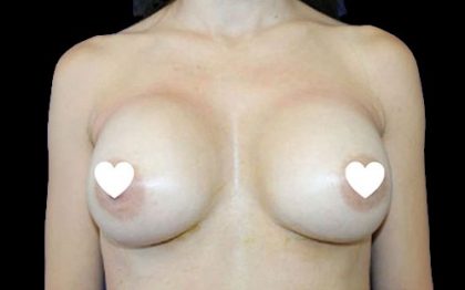 Breast Augmentation (Silicone) Before & After Patient #566