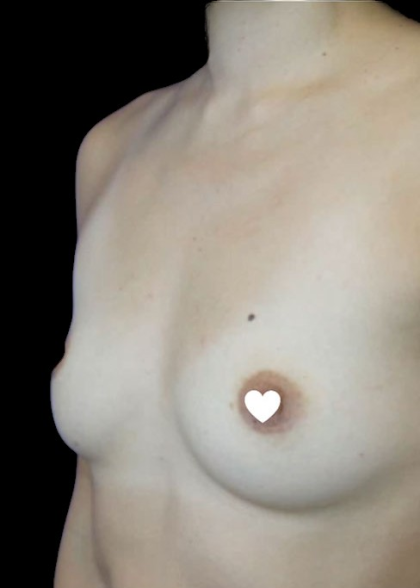 Breast Augmentation (Silicone) Before & After Patient #569