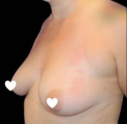 Breast Augmentation (Silicone) Before & After Patient #574