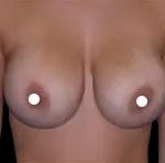 Breast Augmentation (Silicone) Before & After Patient #583