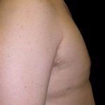 Gynecomastia Before & After Patient #641