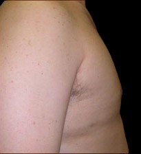 Gynecomastia Before & After Patient #641