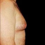 Gynecomastia Before & After Patient #643