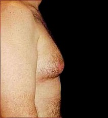 Gynecomastia Before & After Patient #643