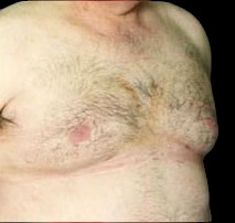 Gynecomastia Before & After Patient #646
