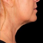 Kybella Before & After Patient #1212