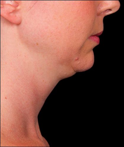 Kybella Before & After Patient #1215