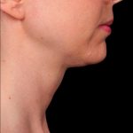 Kybella Before & After Patient #1215