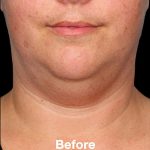 Kybella Before & After Patient #1216
