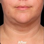 Kybella Before & After Patient #1216