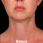 Kybella Before & After Patient #1217