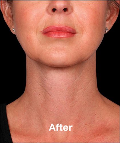 Kybella Before & After Patient #1217