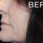 Lip Lift Before & After Patient #956