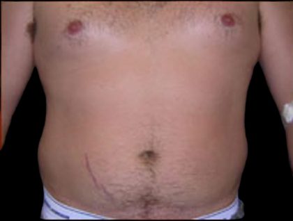 Liposuction Before & After Patient #859