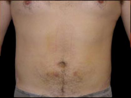 Liposuction Before & After Patient #859