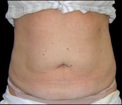 Liposuction Before & After Patient #865