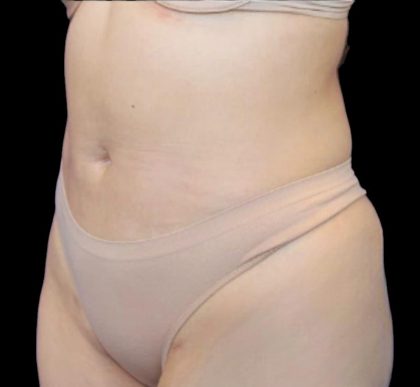Liposuction Before & After Patient #875